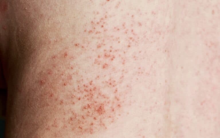 skin rash